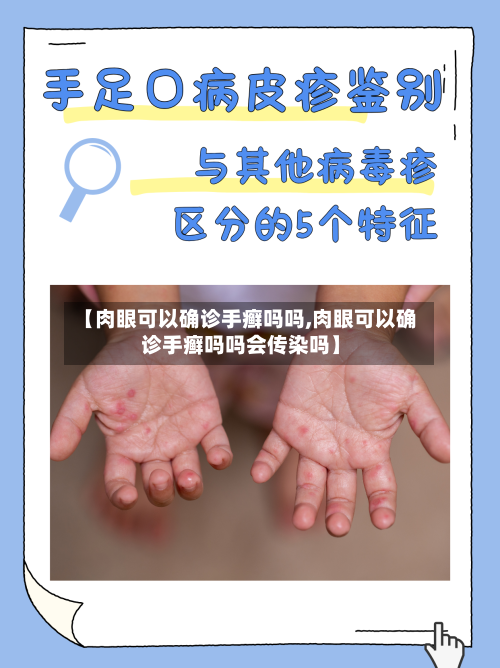 【肉眼可以确诊手癣吗吗,肉眼可以确诊手癣吗吗会传染吗】-第3张图片